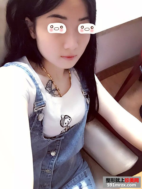 超声刀除皱真实案例恢复图