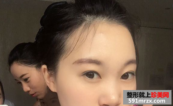 自体脂肪丰额头真实案例恢复图
