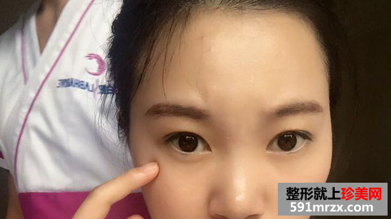 自体脂肪丰额头真实案例恢复图