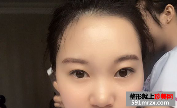 自体脂肪丰额头真实案例恢复图