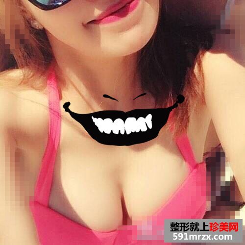假体隆胸真实案例恢复图