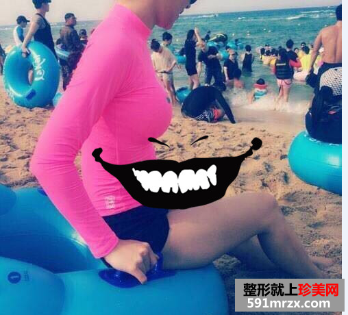 假体隆胸真实案例恢复图