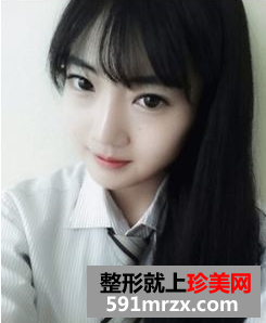 下颌角整形后成功拥有瓜子小脸！