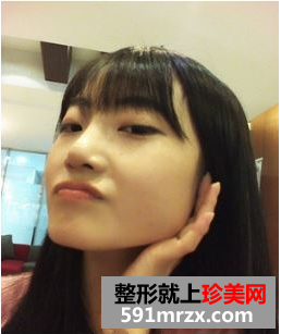 下颌角整形，瓜子脸得来全不费工夫