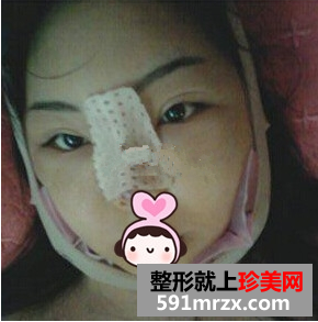 一次隆鼻整形让我永久拥有高挺美鼻