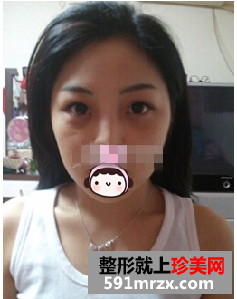 一次隆鼻整形让我永久拥有高挺美鼻