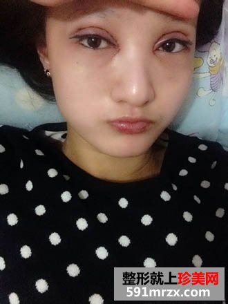 终于做了开眼角和全切双眼皮 恢复ing