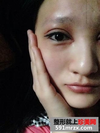 终于做了开眼角和全切双眼皮 恢复ing