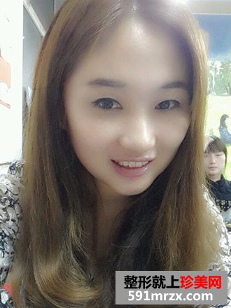 单眼皮妹纸割双眼皮实现美丽双眼的愿望