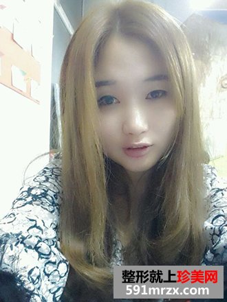 单眼皮妹纸割双眼皮实现美丽双眼的愿望