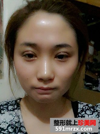 单眼皮妹纸割双眼皮实现美丽双眼的愿望