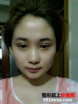 单眼皮妹纸割双眼皮实现美丽双眼的愿望