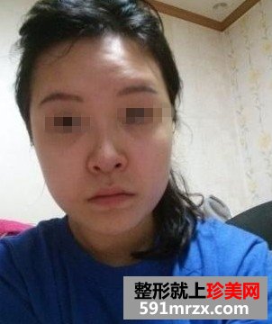 磨骨整形+双眼皮手术后年轻美貌