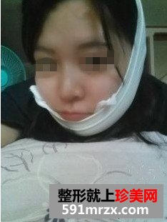磨骨整形+双眼皮手术后年轻美貌