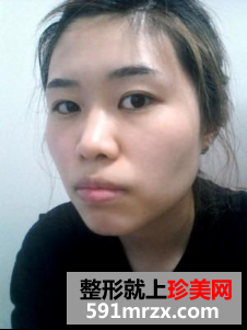 割双眼皮+硅胶隆鼻+面部轮廓整形前后对比