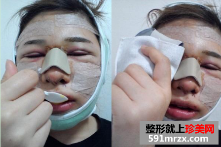 割双眼皮+硅胶隆鼻+面部轮廓整形前后对比