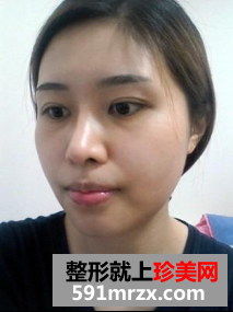 割双眼皮+硅胶隆鼻+面部轮廓整形前后对比
