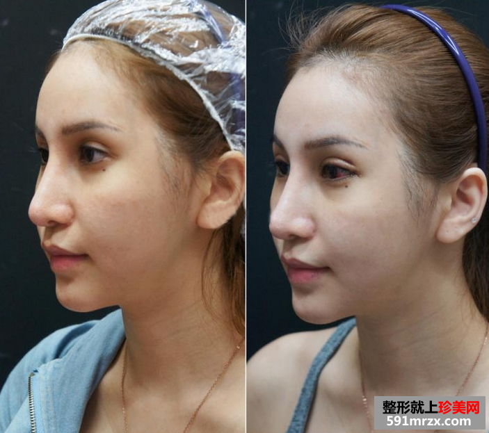 广州美莱开眼角前后对比照片图
