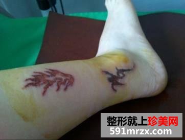 激光洗纹身后的效果图