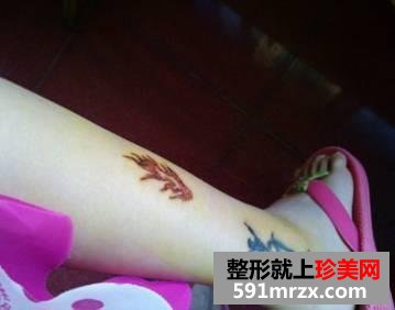 激光洗纹身后的效果图