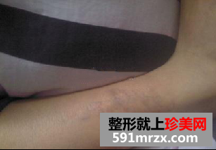 激光洗纹身后的效果图