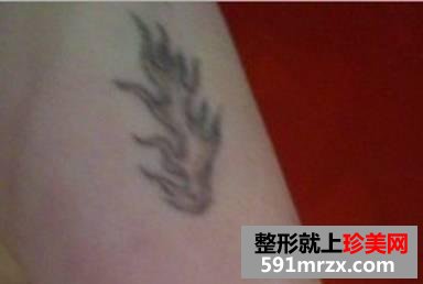 激光洗纹身后的效果图