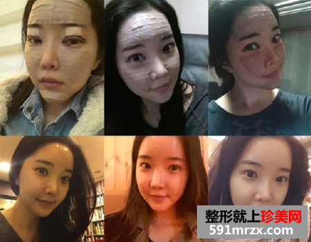 自体脂肪面部填充及双眼皮手术案例恢复过程