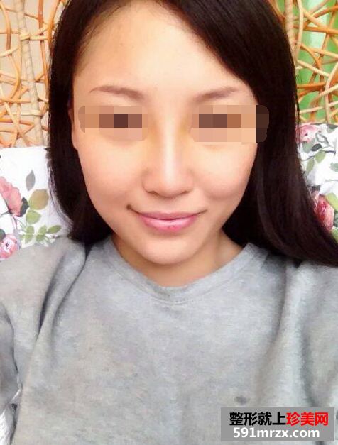 假体隆鼻真实案例对比图
