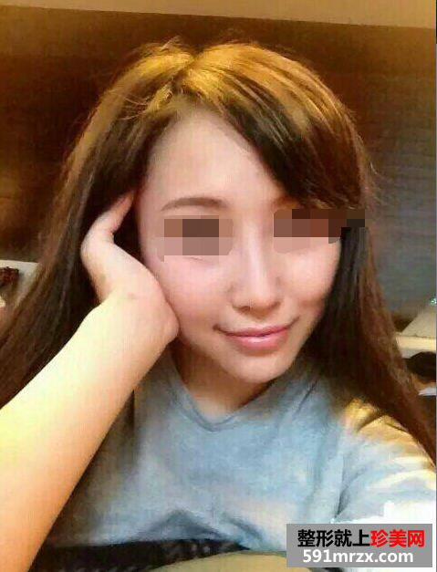 假体隆鼻真实案例对比图