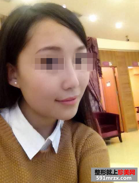 假体隆鼻真实案例对比图