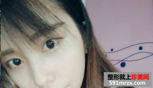 超美鼻综合真实案例对比图