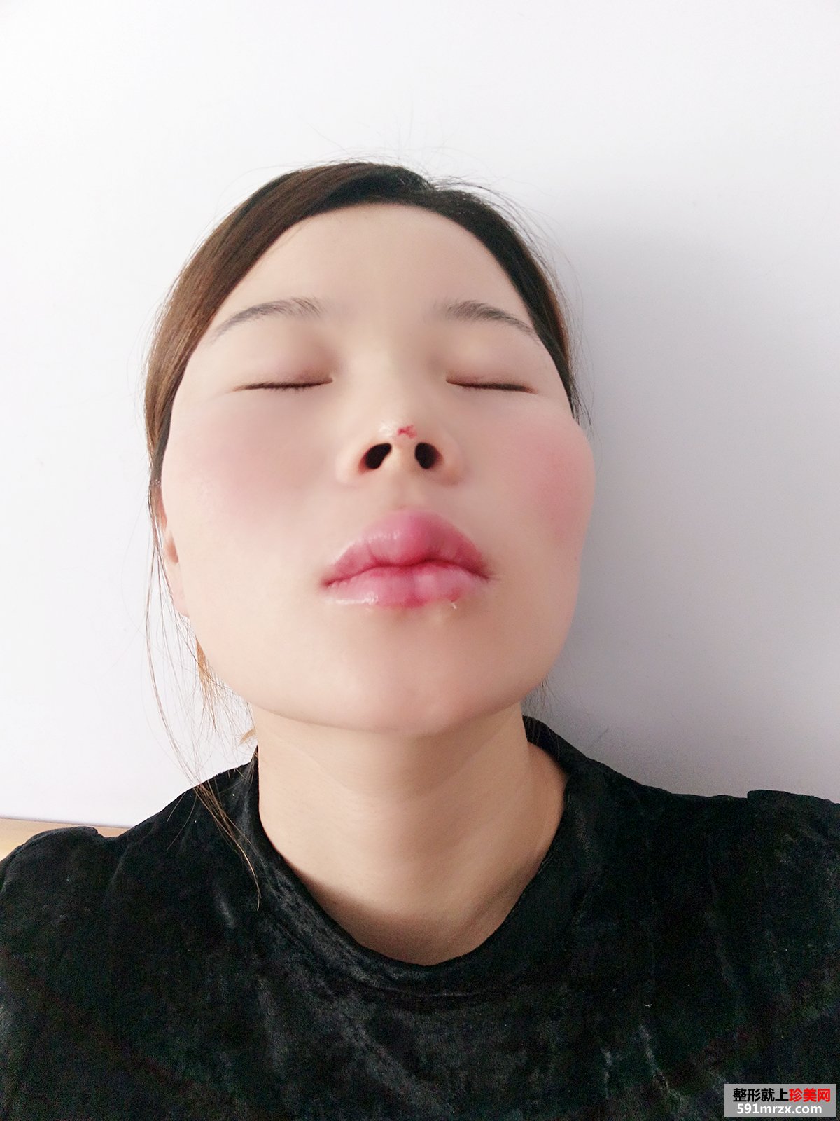 玻尿酸填充太阳穴+胶原蛋白注射隆鼻前后对比效果图片恢复过程分享