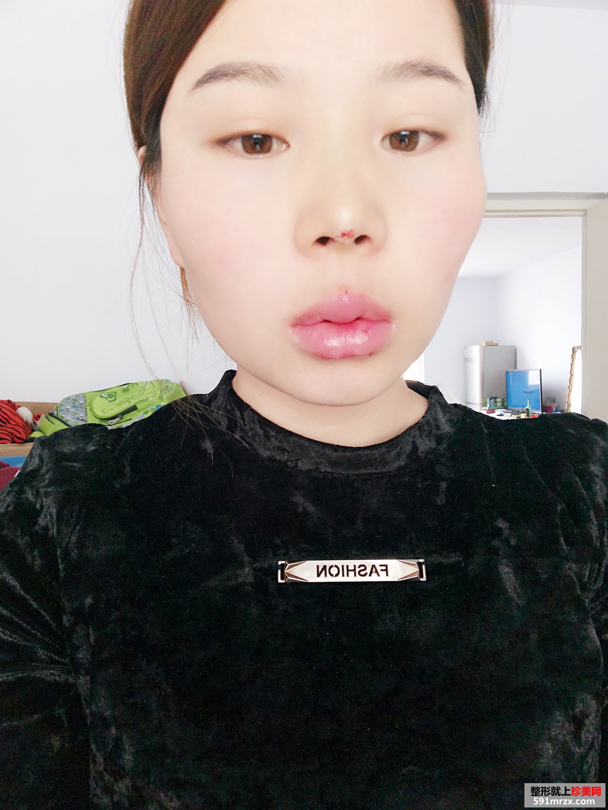玻尿酸填充太阳穴+胶原蛋白注射隆鼻前后对比效果图片恢复过程分享
