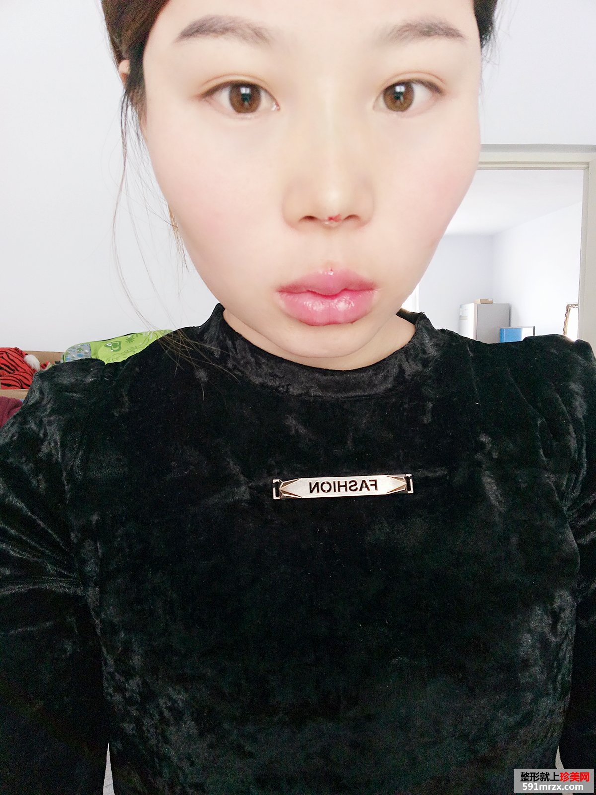 玻尿酸填充太阳穴+胶原蛋白注射隆鼻前后对比效果图片恢复过程分享