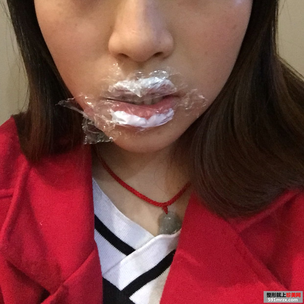 美铝注射瑞蓝玻尿酸丰唇手术前后对比效果图片恢复过程分享