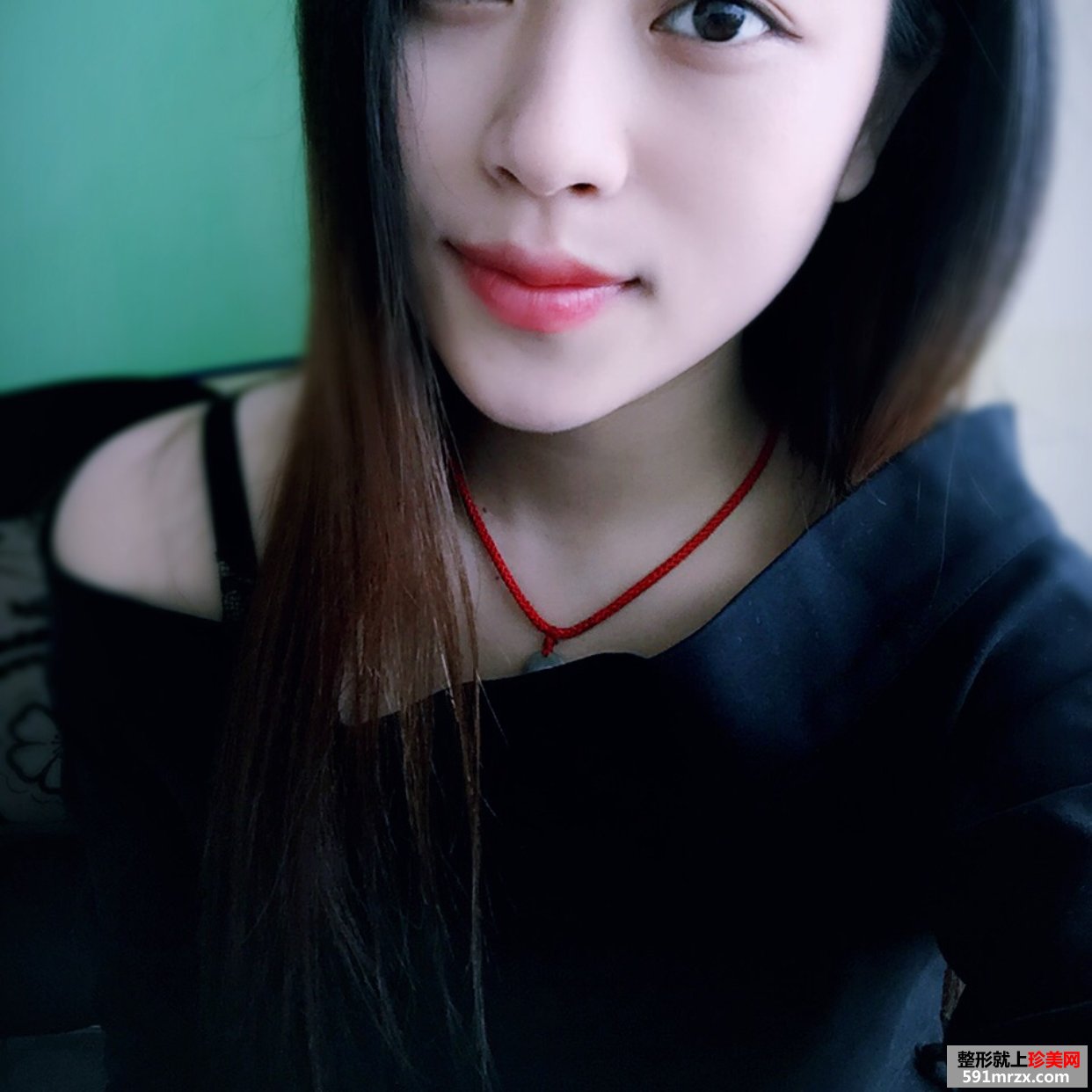美铝注射瑞蓝玻尿酸丰唇手术前后对比效果图片恢复过程分享