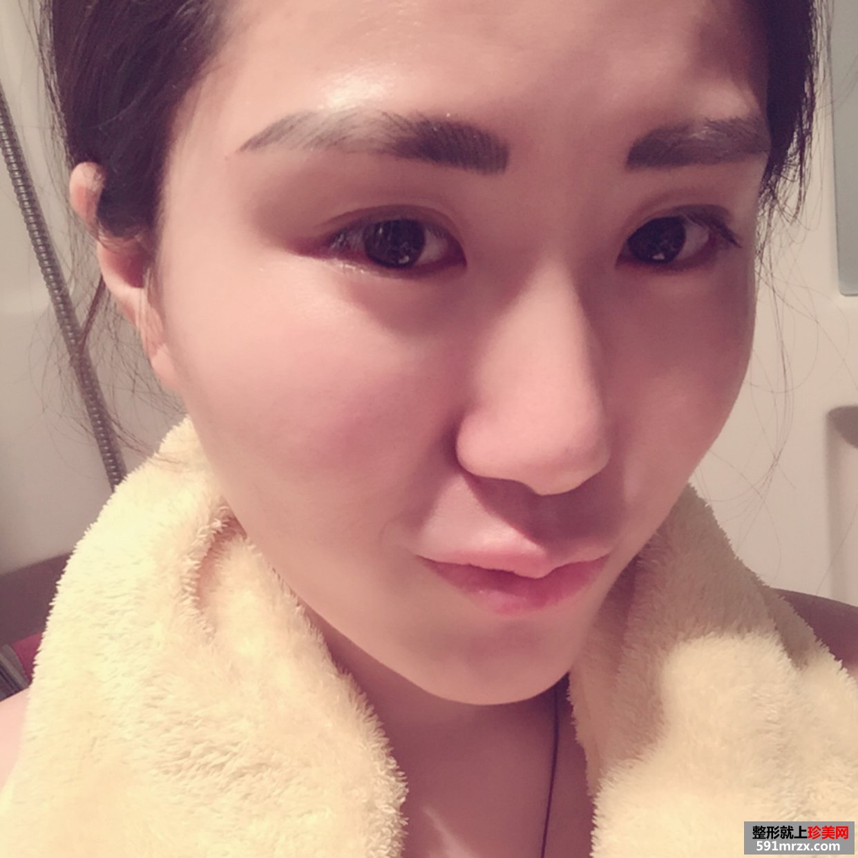 玻尿酸丰唇珠的效果好吗？来看看我的恢复前后对比效果图片吧！