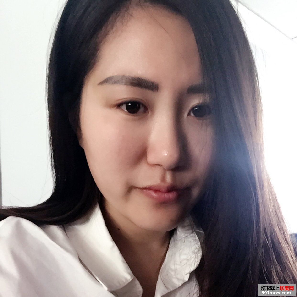 玻尿酸丰唇珠的效果好吗？来看看我的恢复前后对比效果图片吧！