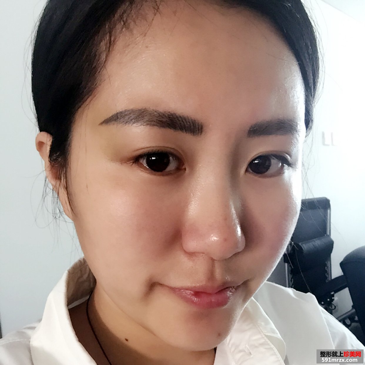 玻尿酸丰唇珠的效果好吗？来看看我的恢复前后对比效果图片吧！