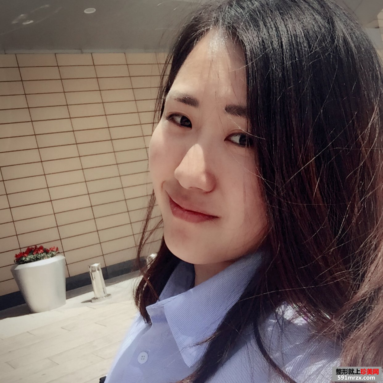 玻尿酸丰唇珠的效果好吗？来看看我的恢复前后对比效果图片吧！