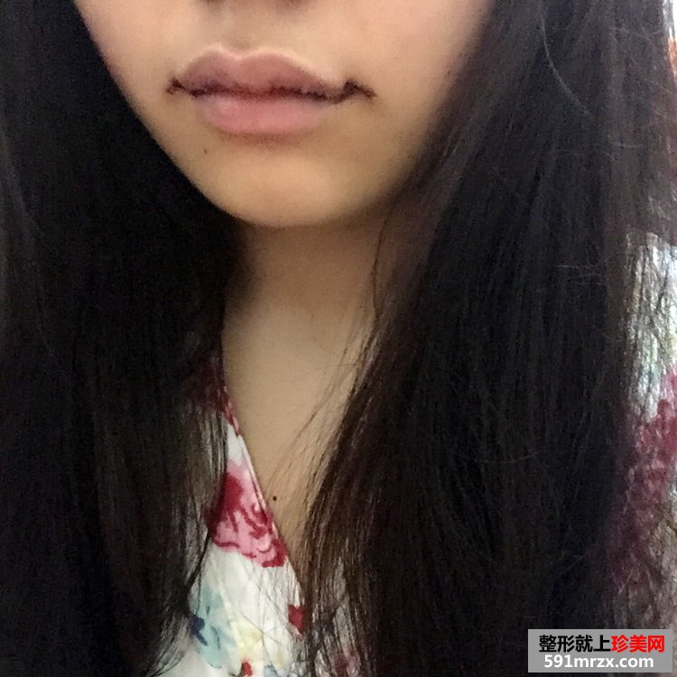 M唇+嘴角上提手术前后对比效果照片分享，还有恢复过程哦！