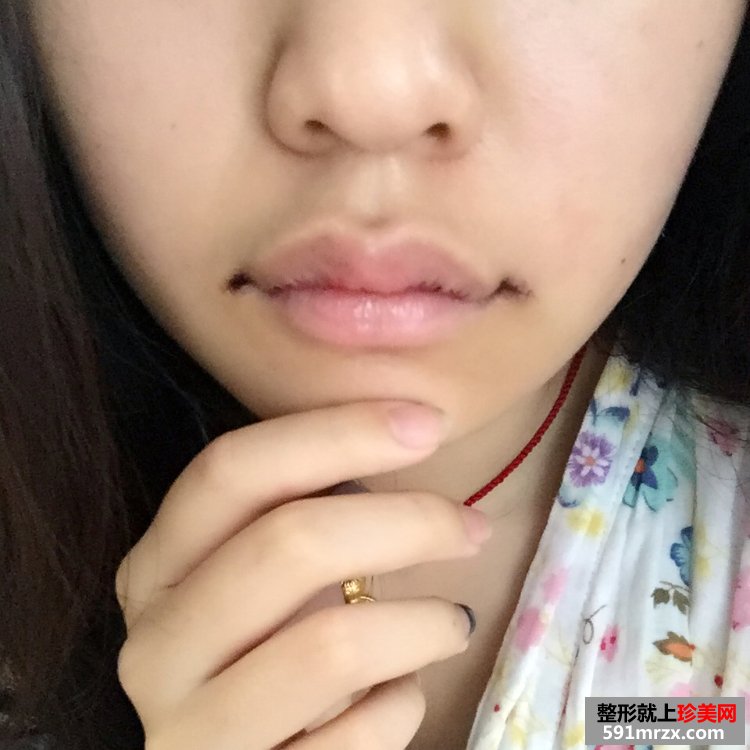 M唇+嘴角上提手术前后对比效果照片分享，还有恢复过程哦！