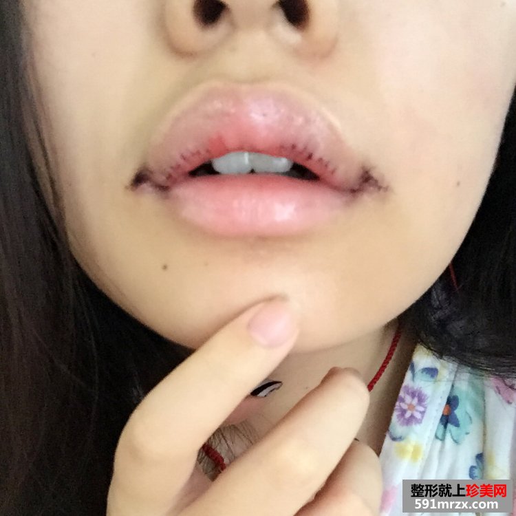 M唇+嘴角上提手术前后对比效果照片分享，还有恢复过程哦！
