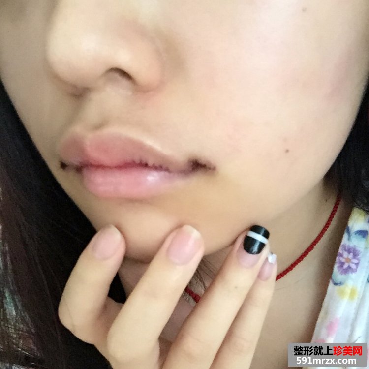 M唇+嘴角上提手术前后对比效果照片分享，还有恢复过程哦！