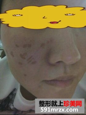 铒激光去痘印还我光滑细腻的皮肤
