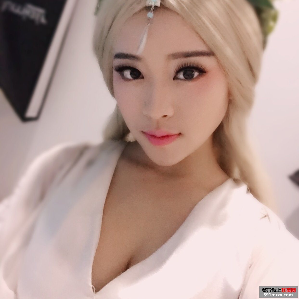 美铝注射瑞蓝玻尿酸丰唇手术前后对比效果图片恢复过程分享