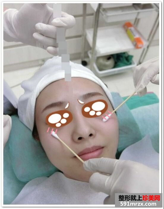 瘦脸针+玻尿酸隆案例效果图分享