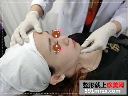 给大家看看我玻尿酸隆鼻+垫下巴的效果