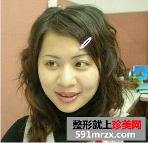 打瘦脸针实现了拥有鹅蛋脸的愿望