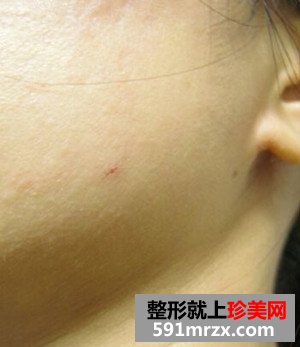 打瘦脸针实现了拥有鹅蛋脸的愿望